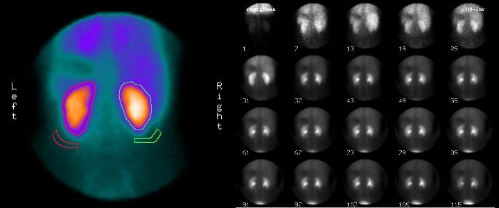 Renograma diurético